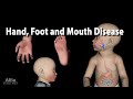 Hand Foot and Mouth Disease, Animation