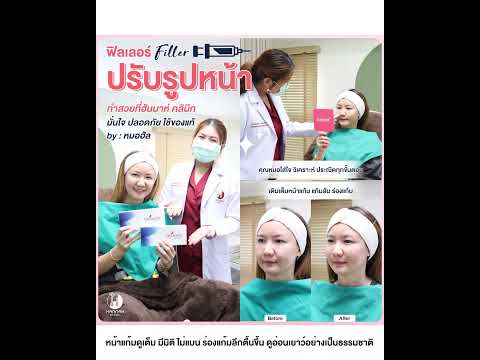 รีวิวหัตถการโปรแกรม Filler หน้าแก้ม ร่องแก้ม