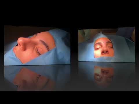 Rinoplasti öncesi ve sonrası