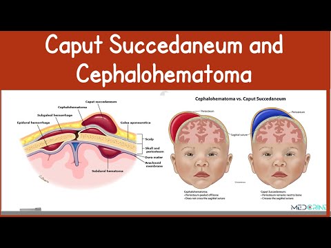 Caput Succedaneum vs Cephalohematoma | Key Differences, Causes, Images and Management Simplified