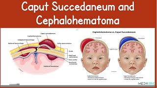 Caput Succedaneum vs Cephalohematoma | Key Differences, Causes, Images and Management Simplified