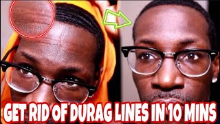 360 WAVES: HOW TO GET RID OF DURAG LINES ON FOREHE