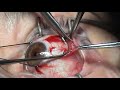 Simulated Surgery Strabismus Surgery Resection Techniques