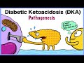 Diabetic Ketoacidosis (DKA) Pathogenesis