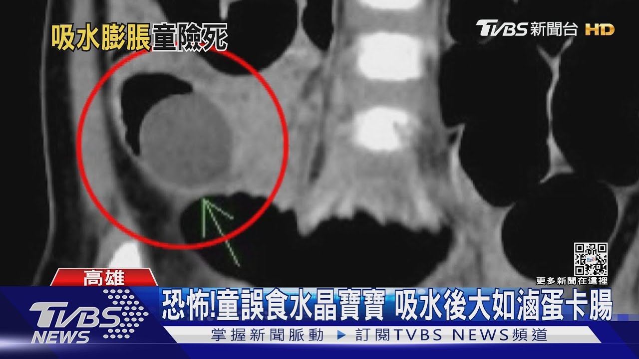 這不能吃！幼童誤食「水晶寶寶」　大如滷蛋卡腸險爆破