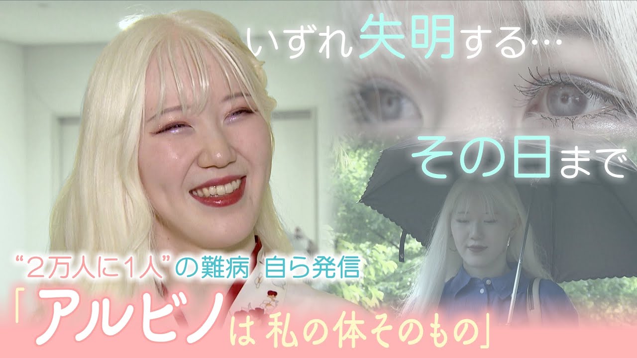 2万人に1人　アルビノの女性