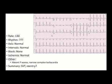 Practice ECG - Basics (2-10)