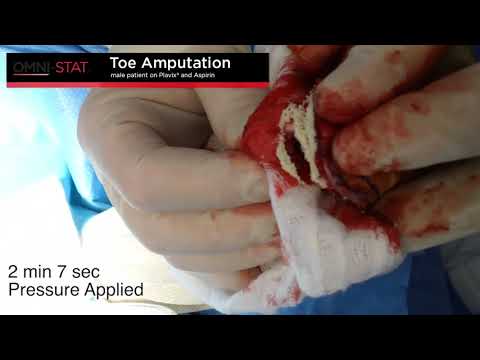 Toe Amputation Bleeding Control in Surgery 