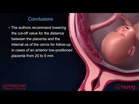 New UOG video abstract on placenta previa and low‐lying placenta second trimester ultrasound