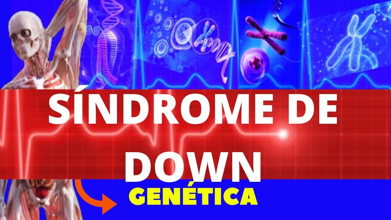 SÍNDROME DE DOWN - (O QUE É, CAUSAS CARACTERÍSTICAS DIAGNÓSTICO E TRATAMENTO) TRISSOMIA 21 GENÉTICA