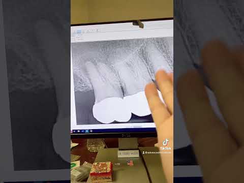 RCT of a calcified tooth #2 through a crown and in one visit.