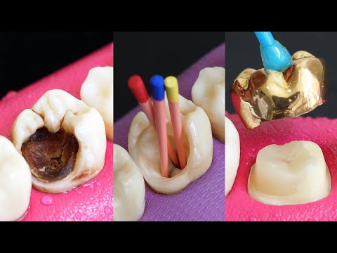 Classic Restoration Of Decayed Tooth By Root Canal And Gold Crown