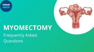 Myomectomy - Frequently Asked Questions