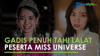 Potret Gadis Bertahi Lalat di Sekujur Tubuh Ikut Miss Universe, Ini Kabarnya Sekarang