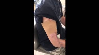 Brachial Plexus Injury Rehabilitation