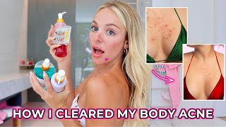 The TRUTH About How I Got Rid of My Body Acne for GOOD | Favorite Products + Tips!