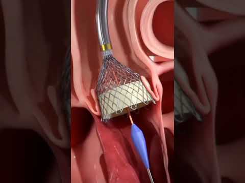 Transcatheter aortic valve implantation procedure (TAVI)