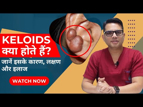 What are the Keloids? | Keloid Treatment in Delhi | Best Skin Clinic Delhi | SkinQure | Dr Jangid