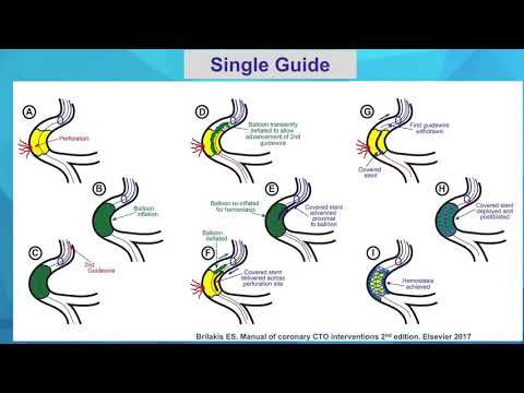 CVI 2020_0710_830 Large Vessel Perforation_Hall