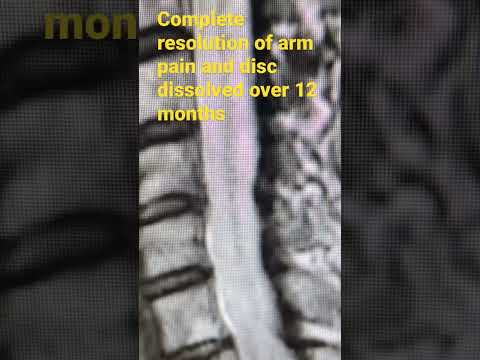 Can a cervical disc herniation fix itself ?