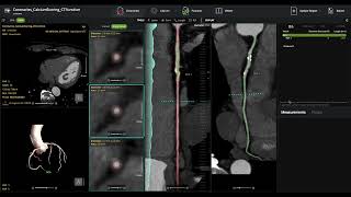 cvi42 | Plaque overview and demo