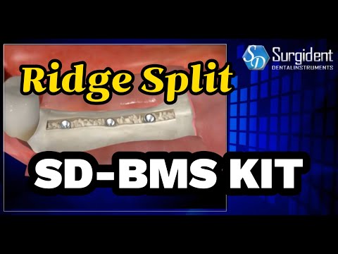 Ridge split system