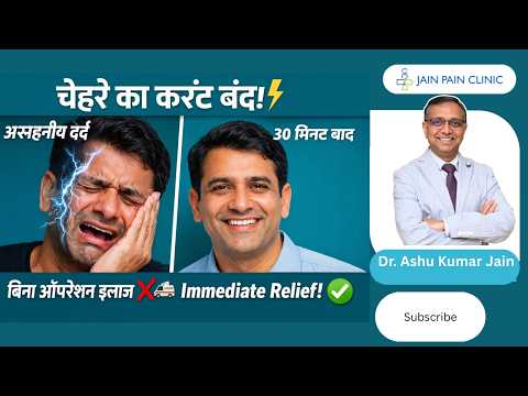 Watch video on Trigeminal Ganglion RFA