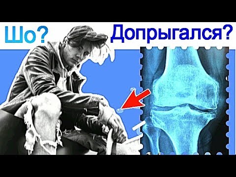 Дисплазия тазобедренных суставов упражнения взрослых Гимнастика попова для остеохондроза