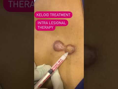 Keloid/keloid treatment/keloid laser treatment/keloid scar treatment/dermatologist surat