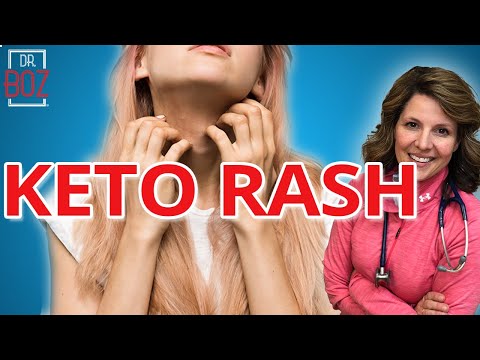 Why do you get Keto Rash? and how to Cure it! | Dr. Boz