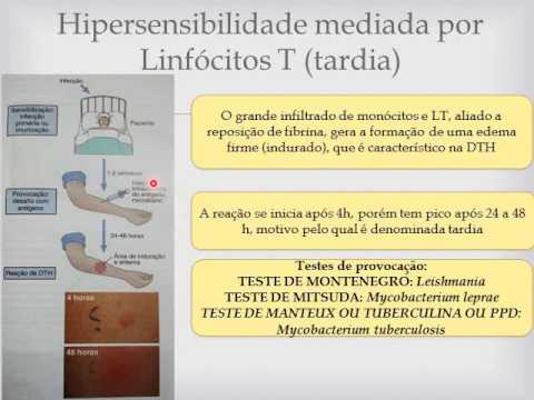 Hipersensibilidades4