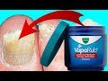 How To Use Vicks To Treat & Cure Toenail Fungus - FAST EASY REMEDY