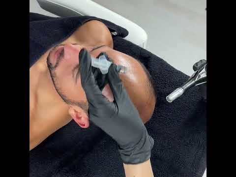 Micro Needling Fusion Hair