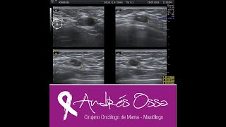 Marcacion Clip de  Titanio