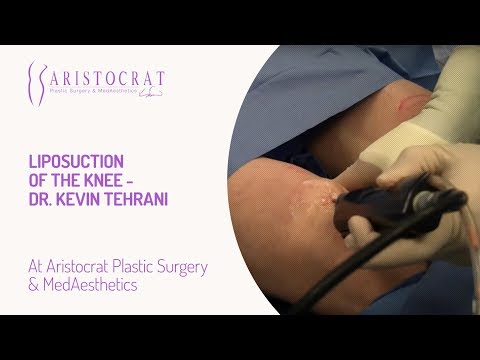 Liposuction of the Knee