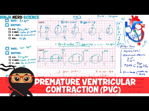 Rate and Rhythm | Premature Ventricular Contraction (PVC)