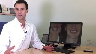 Severe crowding, midline Deviation and gummy smile solved with Invisalign assisted by TADS