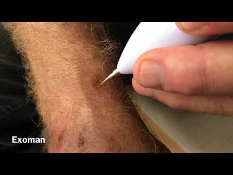 How to remove sun spots, age spots and moles DIY