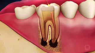 Root canal Dentist Treatment Park Slope