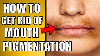 How to Get Rid of Pigmentation Around Mouth Naturally