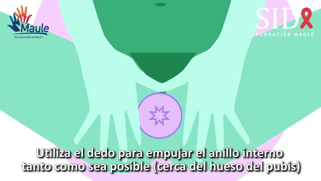 (VIDEO) La Fundación Sida Maule alerta baja utilización de condón para prevenir el VIH 