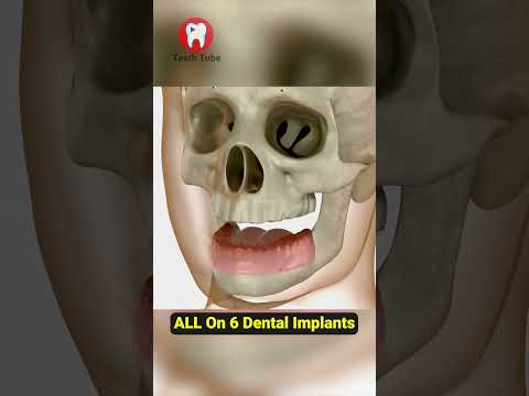 All On 6 Dental Implants #shorts