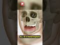 All On 6 Dental Implants Shorts