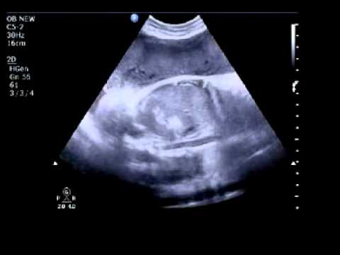 Echogenic Fetal Bowel