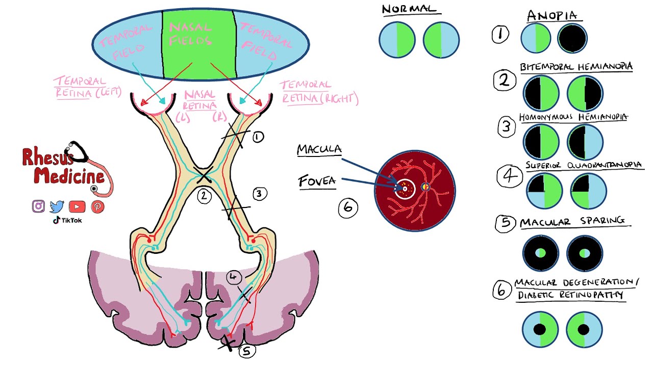 Visual Field Defects Explained