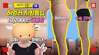 [허엉러 V-로그] 허엉러 지방흡입 수술후 2주차!