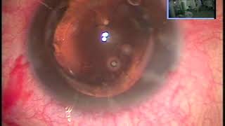 Download Lagu PK for keratoconus of 28years claimed Thumbnail