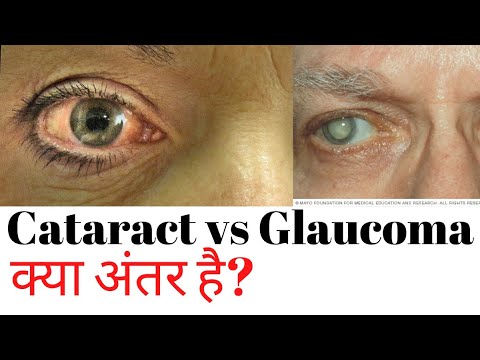 Cataract and glaucoma difference | Glaucoma vs cataract