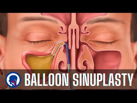 Balloon Sinuplasty Questions & Answers | Capital ENT & Sinus Center