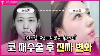 코 재수술 5개월차 리얼 후기 — 자연스러워졌을까? #코재수술 #코성형 #코재수술후기